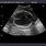 Hydranencephaly Ultrasound Images