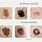 Irregular Moles Skin Cancer