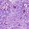 Keratotic Basal Cell Carcinoma