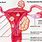 Large Fibroid Uterus