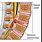 Lumbar Spinal Stenosis L4-L5