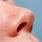 Lump Inside Nose Nostril