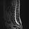 MRI Lumbar Spinal
