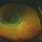 Macula On Retinal Detachment