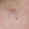 Metastatic Melanoma Skin Cancer