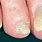 Nail Dystrophy