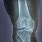 Osteoarthritis Knee X-ray