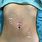 Ovarian Cyst Removal Scar