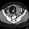 Ovarian Dermoid Cyst CT