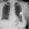 Pacemaker On Chest X-ray