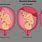 Placental Abruption Pattern