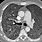 Pneumocystis Pneumonia CT