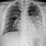 Pneumonia Chest X-Ray Findings