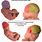 Premature Baby Head Shape