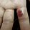 Pyogenic Granuloma On Finger