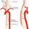 Radicular Artery