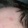 Red Patch On Forehead