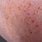 Red Skin Rashes