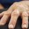 Rheumatoid Arthritis in Hands and Fingers