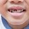 Rotten Teeth in Kids