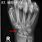 Scaphoid Fracture X-ray