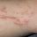Scratch Marks On Skin