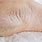 Severe Dry Skin Feet