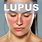 Sintomas Del Lupus