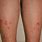 Skin Eruptions On Legs