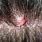 Skin Lesions On Scalp