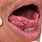 Squamous Cell Carcinoma of Tongue