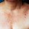 Sun Damaged Skin White Spots