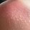 SunBurn Bumps