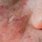 Symptoms of Eczema On Face