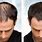 Tamoxifen Hair Loss