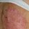 Ten Skin Rash