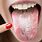 Tongue Fungal Infection