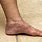 Varicose Veins On Feet