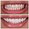 Veneers Teeth Before and After