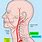 Vertebral Artery Stenosis