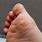 What Causes Warts On Feet