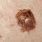 What Does Skin Cancer Moles Look Like