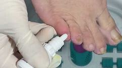 Fungal nail treatment. (Treatment drops shown in the end).