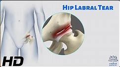 Hip Labral Tear: The Hidden Culprit of Hip Pain