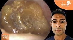 1,089 - Very Satisfying Ear Wax Removal