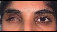 Life like prosthetic eye| Artificial eye movements | Dr Jibran