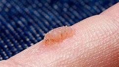 How to Remove Common Hand Warts / Wart & Mole Vanish