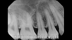 X-Ray lesson series: 1 - Full Mouth X rays