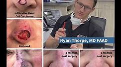 Ada West Dermatology's Dr. Ryan Thorpe talks about Mohs Surgery on the Nose