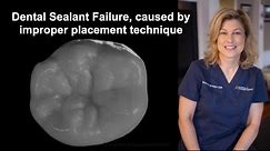 Dental Sealant Failure, caused by improper placement technique.